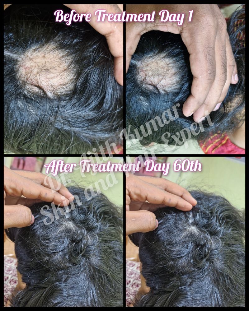 Holistic Skin & Hair Expert in Udupi - Hair Loss Treatment Result