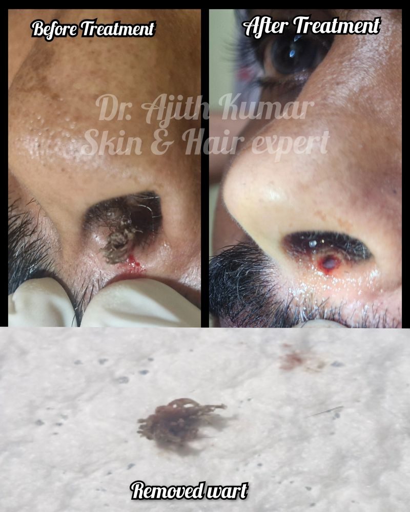 Holistic Skin & Hair Expert in Udupi - Pigmentation Removal