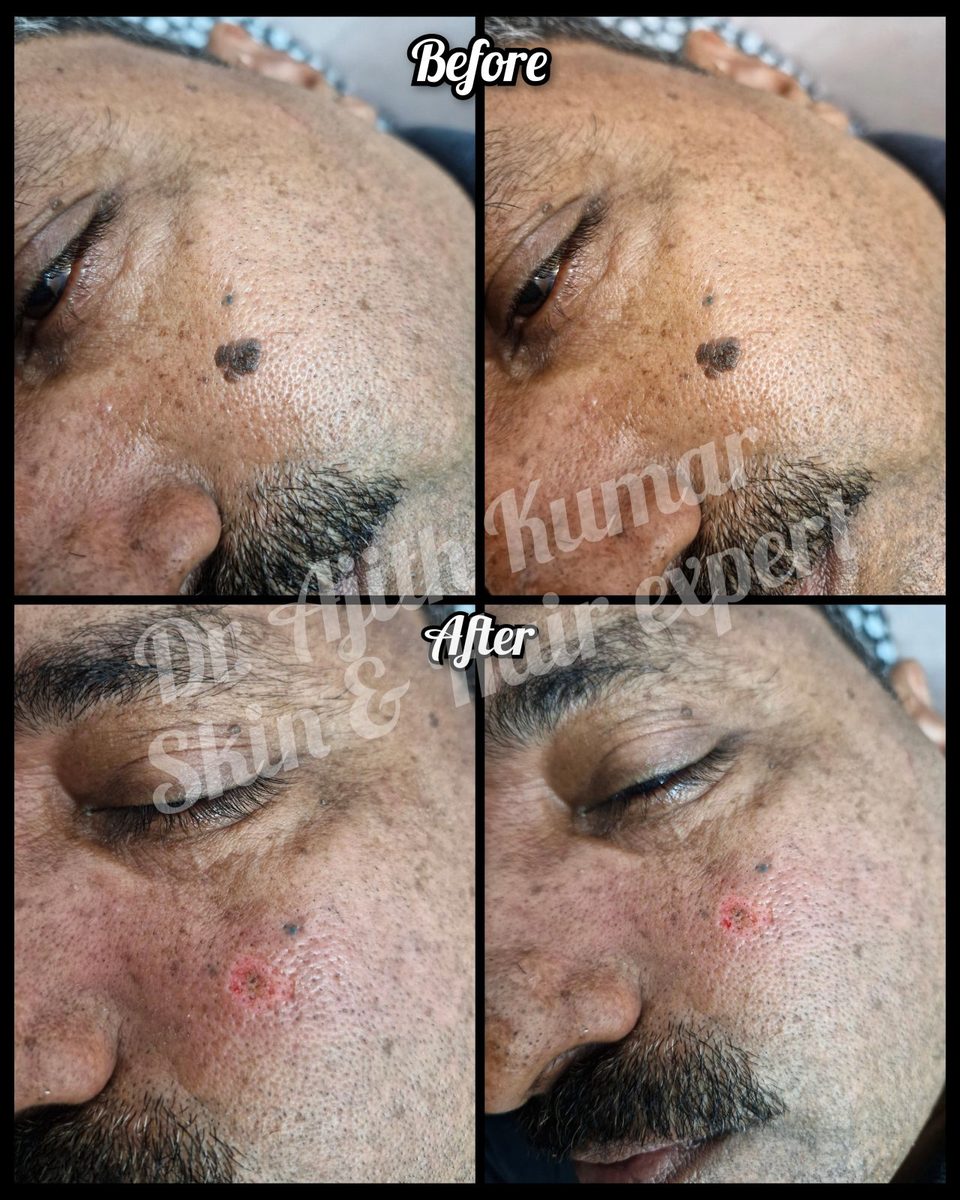 Best Hair Loss Doctor in Udupi - Hair Regrowth