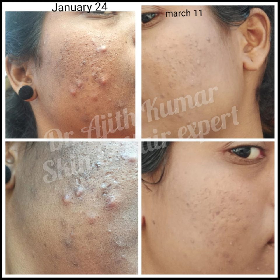Dr Ajith Kumar Udupi - Skin Transformation