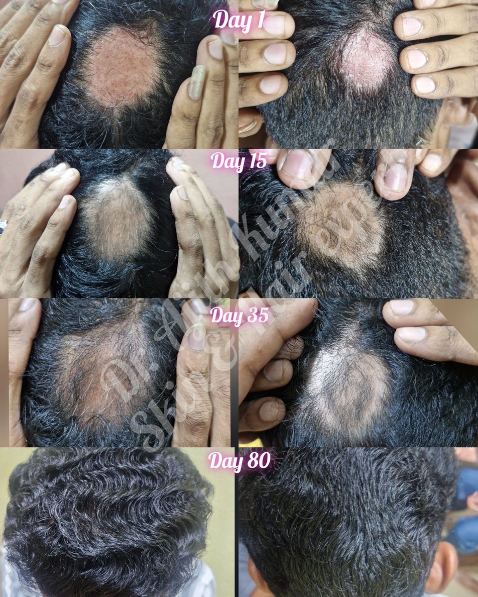 Holistic Skin & Hair Expert in Udupi - Patient Results