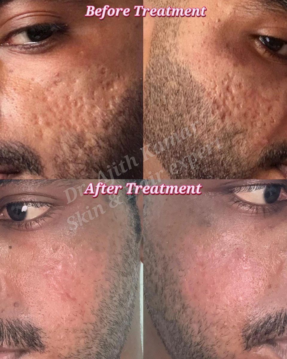 Skin Clinic Udupi - Treatment Outcomes