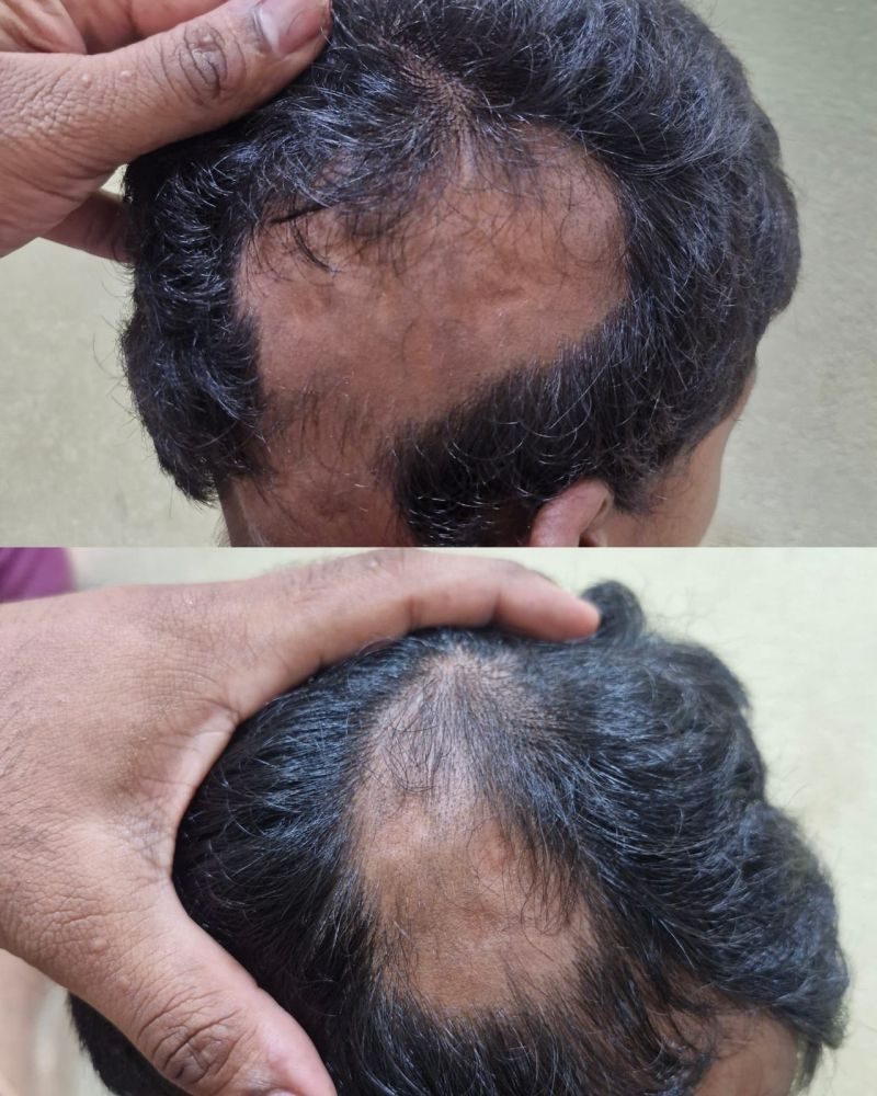 Holistic Skin & Hair Expert Udupi - Clinical Result