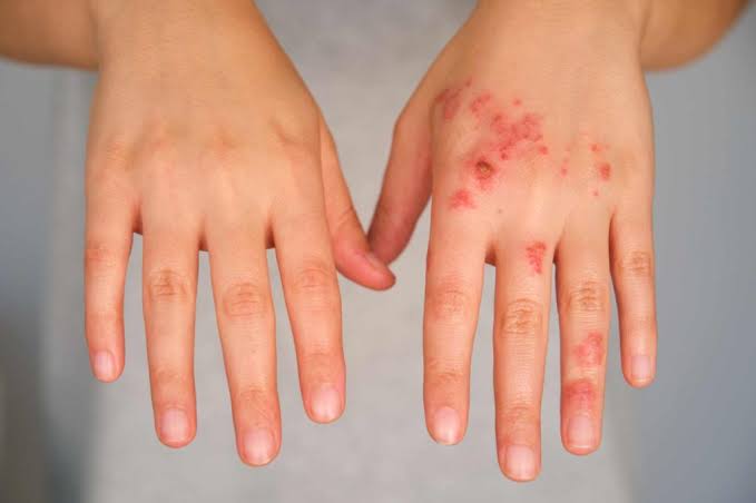 Skin Allergy Doctor Udupi