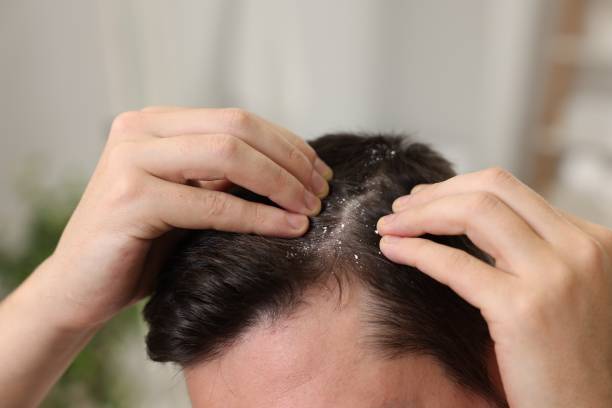 Dandruff Specialist Udupi